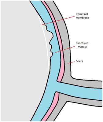 Pathophysiology and clinical aspects of epiretinal membrane – review